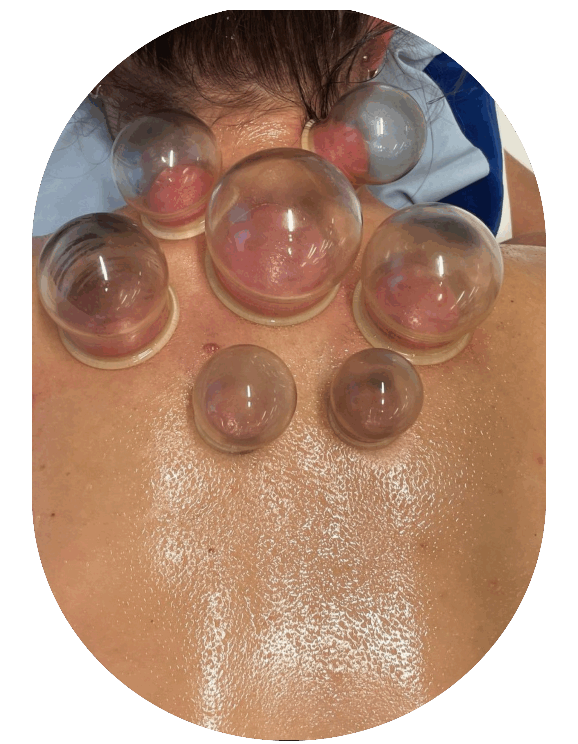 Schröpfen einer Person durch eine medizinische Masseurin.